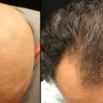 minoxidil is used for hair growth